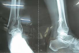 Gãy xương mắt cá chân - Hình ảnh minh họa